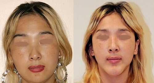 Rhinoplasty Patient Before & After Photo