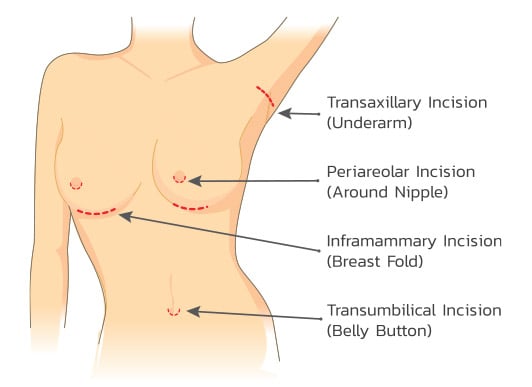 The diagram illustrates the different approaches or incision sites for the placement of breast implants during breast augmentation. 
The 4 approaches are: transaxillary, periareolar, inframammary & transumbilical. Transumbilical isn't considered an appropriate or reasonable approach for the majority of patients receiving breast implants. It's merely shown in the diagram to reinforce it's uselessness.