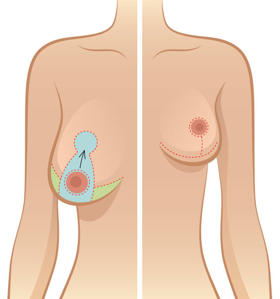 The different types of breast lifts