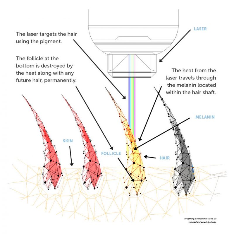 Laser Hair Removal