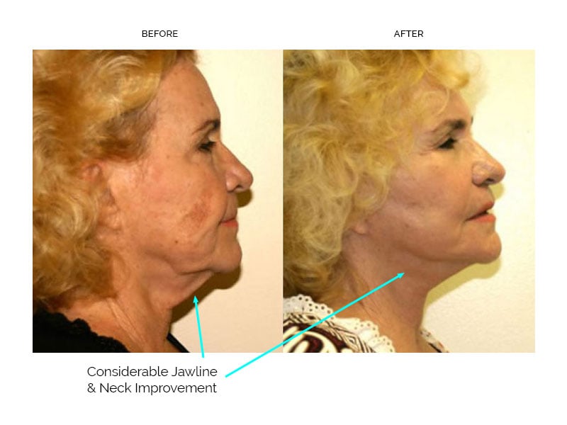 Many plastic surgeons turn to one of the deep plane lifts such as SMAS facelift, in order to take care of the jowls that hang down over the sides of the chin and over the mouth area. A mini facelift is not a good solution for jowls.