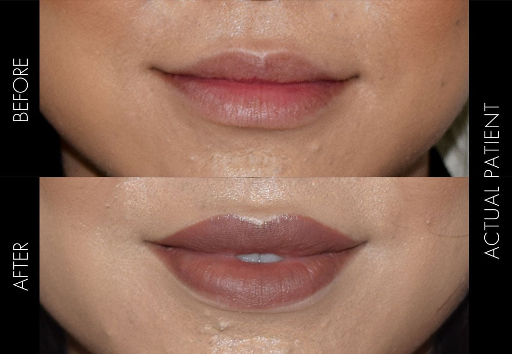Before and after images of a patient who has received lip injections to improve the size, shape and volume of the lips. Hyaluronic acid filler was used for the treatment.