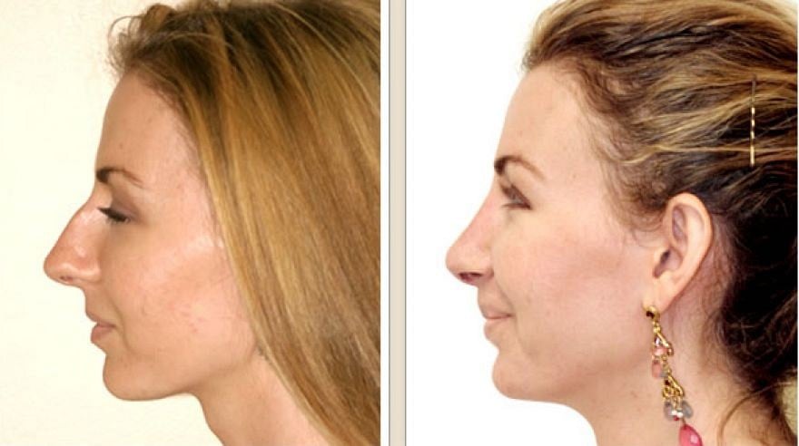 Rhinoplasty Patient Before & After Photo