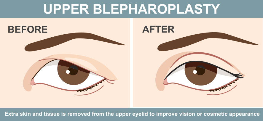 The illustration depicts one of the operative goals of upper blepharoplasty surgery. The image shows postoperative outcome from the removal of excess skin from the upper lid which had resulted in a condition called hooding where the excess skin begins to drop over from the top of the upper lid.  
